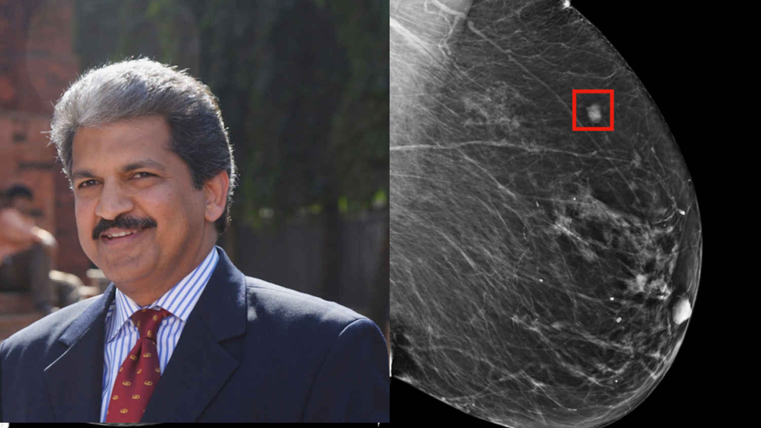 AI predicts Breast Cancer 5 years in advance, Anand Mahindra reacts