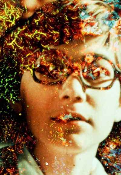 Pigment-Dispersion Syndrome