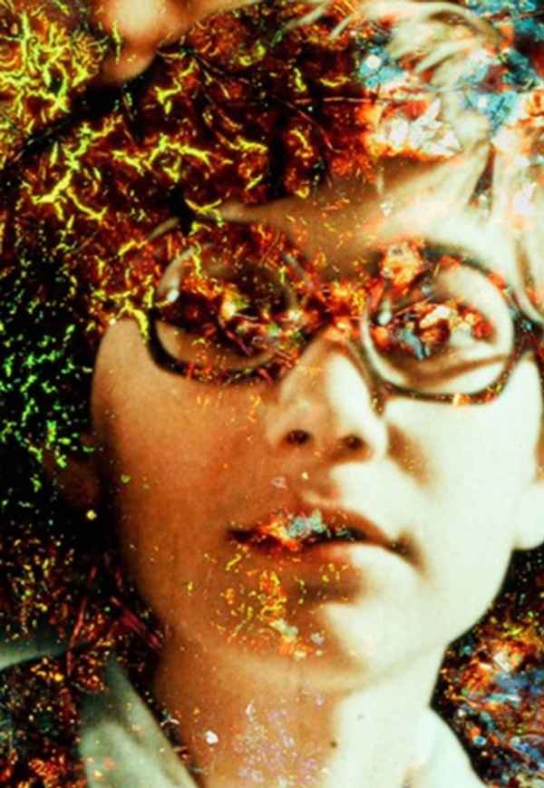 Pigment-Dispersion Syndrome Poster 2